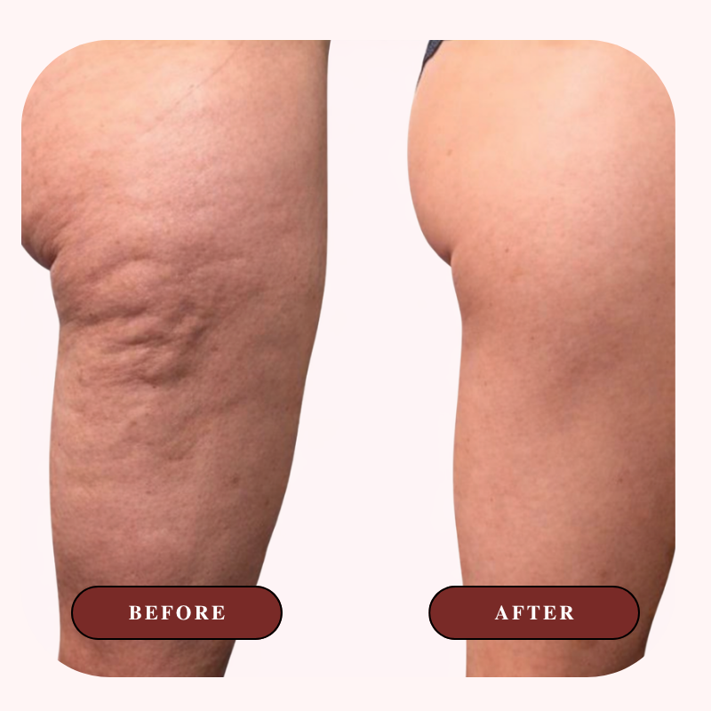 Cellulite Sculpting Oil
